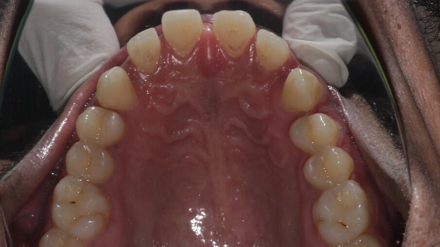 Fig 4: Pre-op Maxillary Arch