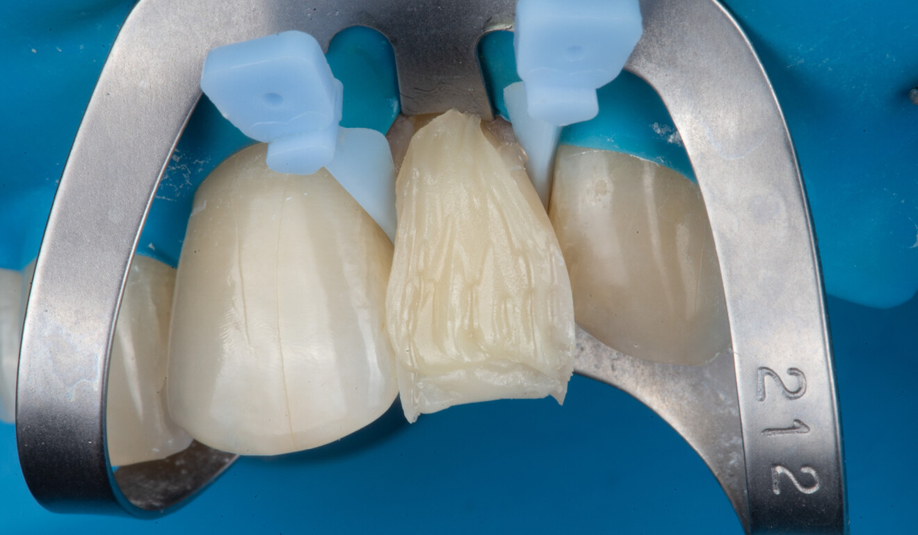 Fig. 4: Single-shade layering of the labial surface.