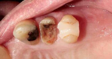 Atraumatic extraction of maxillary first premolar