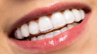 Align Technology présente Invisalign Go Plus
