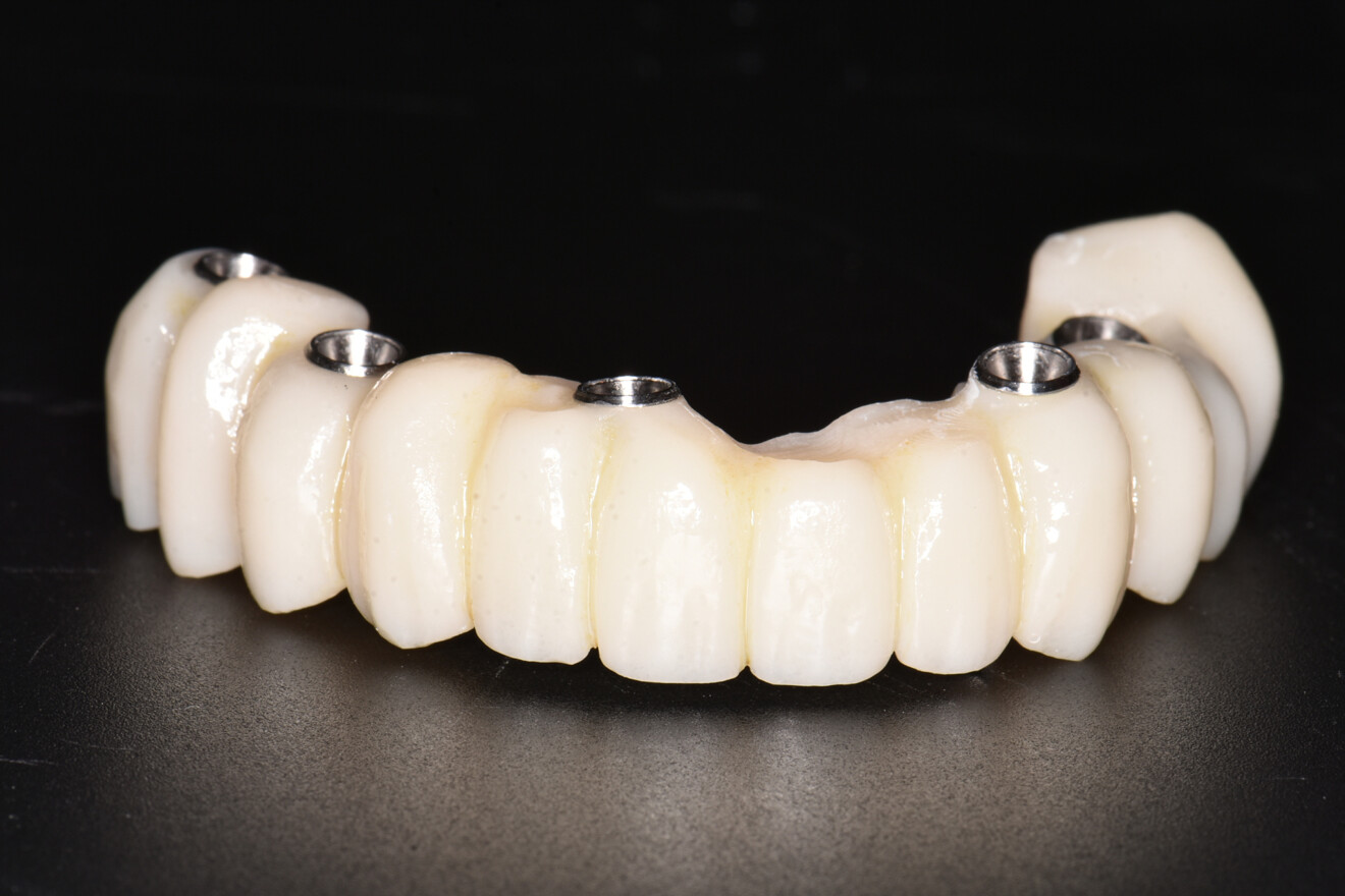 Fig. 5e: All-on-5 provisional restoration, shown extraorally.