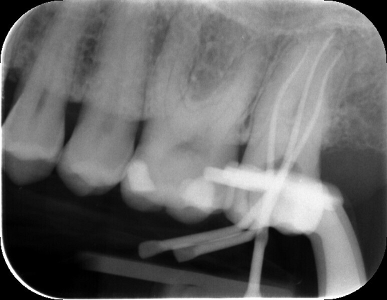 Fig. 6b: Master point fitting with 30/.04 HyFlex EDM gutta-percha points. Intra-oral view (a). Radiograph (b). Individual gutta-percha points (c).