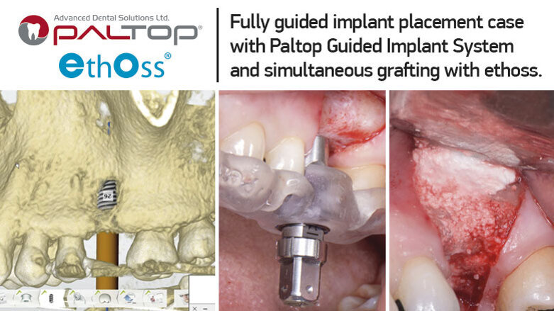 Fully guided implant placement case with Paltop Guided Implant System and simultaneous grafting