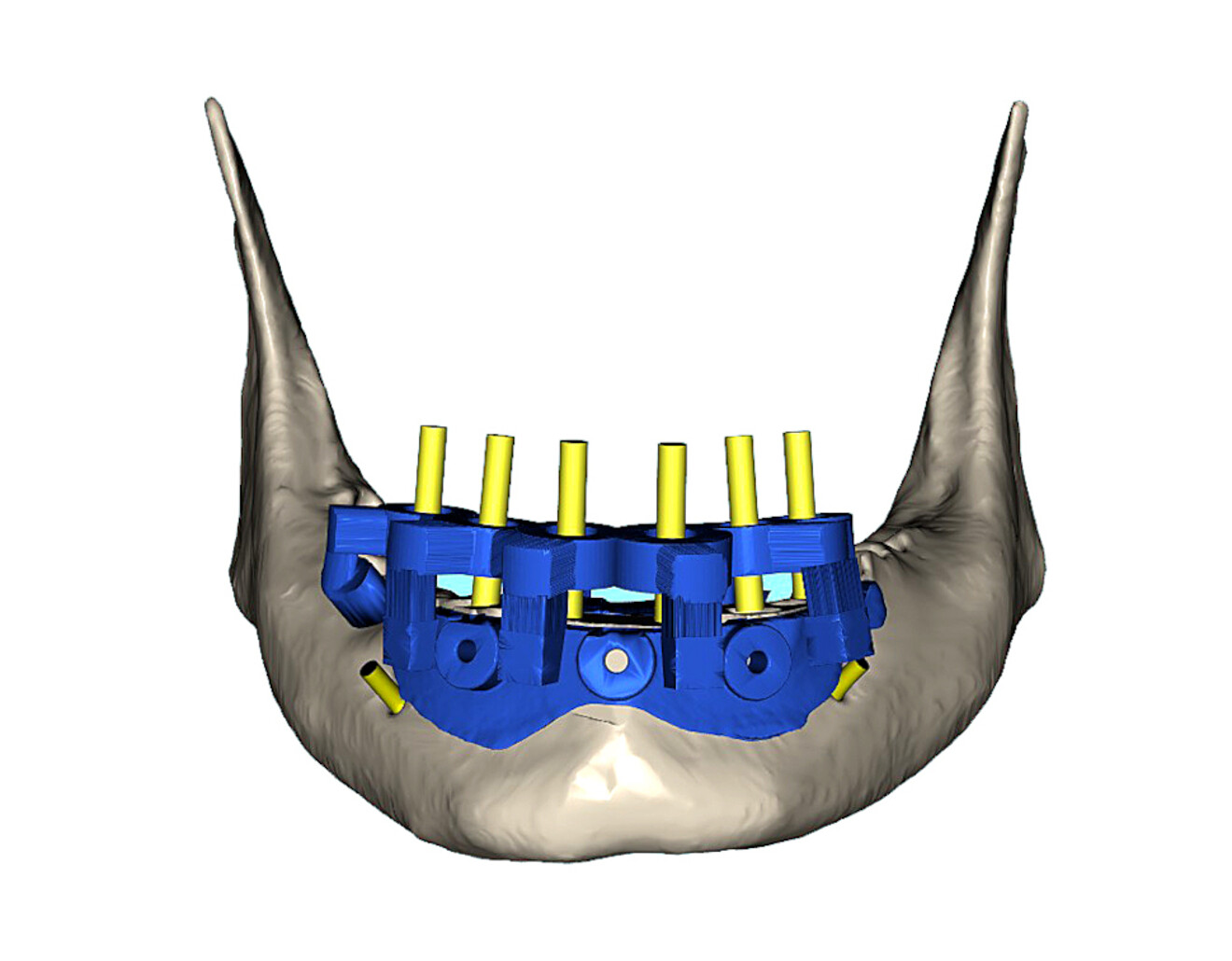 Fig. 15b: Simulation of the surgical guide (blue), demarcating the bone reduction, seated securely on the mandibular bone for precise osteotomy preparation.