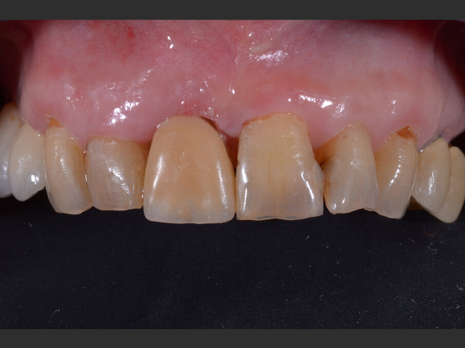 Fig. 5 - Valutazione post-operatoria con il provvisorio in situ - visione frontale.