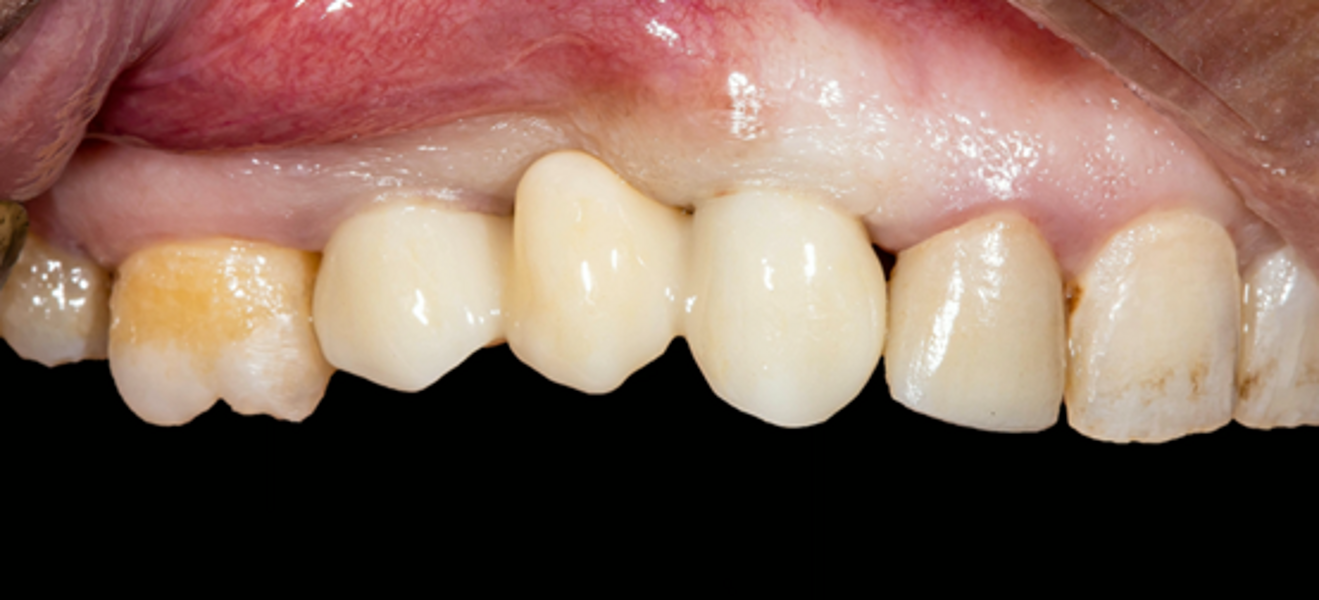 Fig. 14: Final restoration in the patient’s mouth, left lateral view.