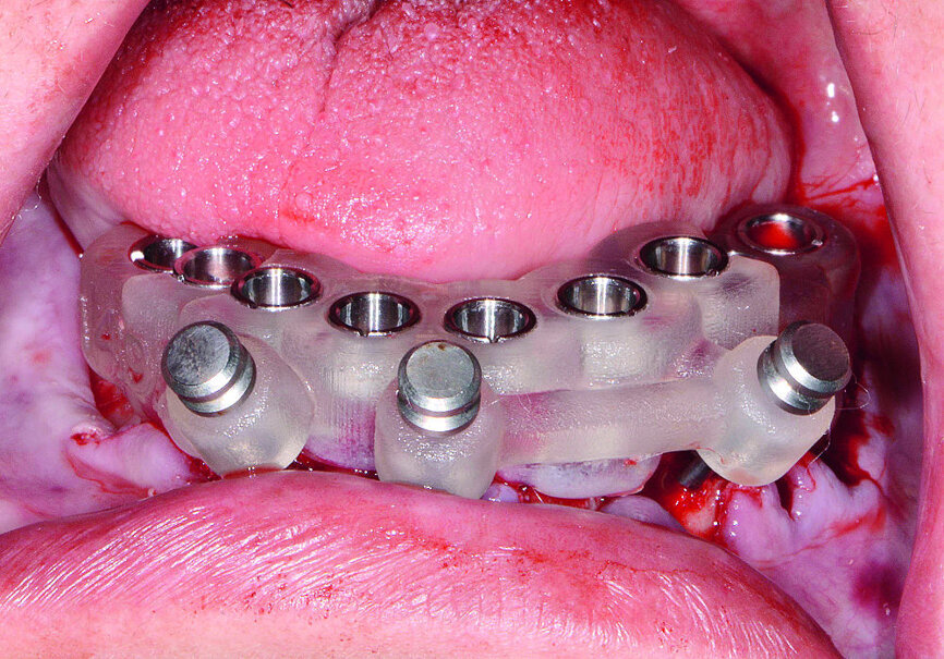 Fig 14 Guide chirurgical mandibulaire stabilisé