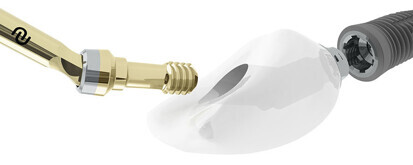 Angulated Screw Access Solution