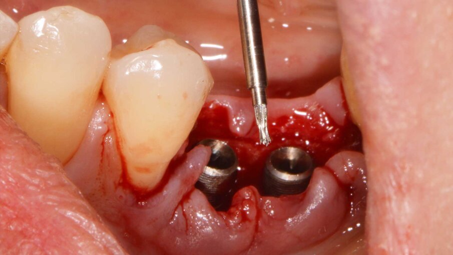 Fig. 3 - Decontaminazione della superficie perimplantare.