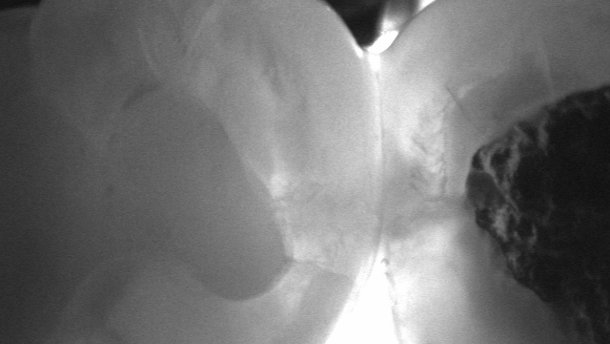 Near-infrared transillumination: Expert introduces X-ray-free caries diagnostic