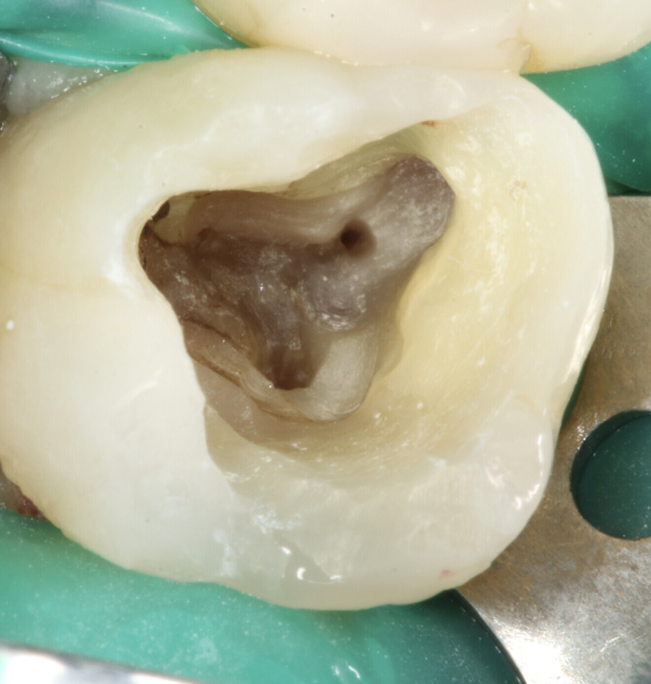 Fig. 2: Image of the access cavity prepared, showing excess removal of healthy tissue in the mesiobuccal and apical direction.