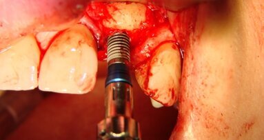 Rekonstrukcja blokiem allogennym wyrostka zębodołowego i wszczepienie implantu