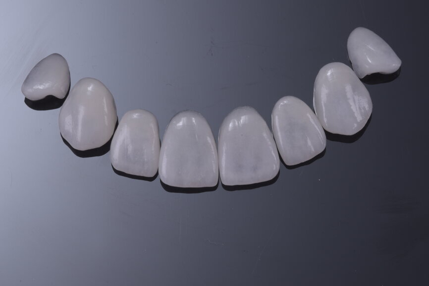 Fig. 78: Veneers adapted to the master dies and ready to be delivered to the dental office.