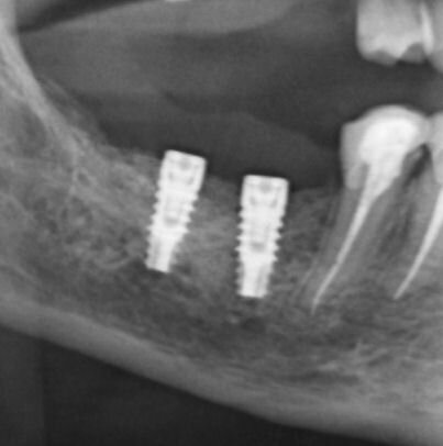 Figg. 15, 16_Controllo radiografico post-implantare e follow-up ad 1 anno.