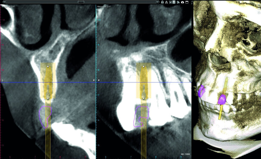 Fig. 3: Digital implant and surgical guide planning in Planmeca Romexis software.