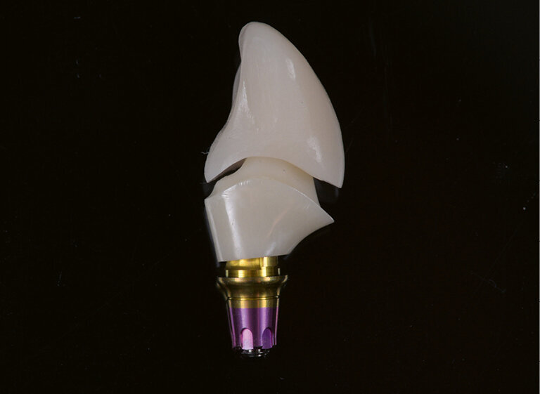 Fig. 8. Immediate temporary restoration