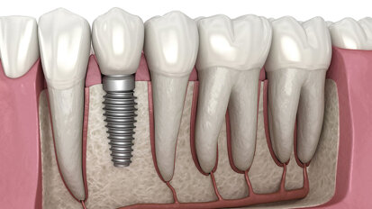 Dental implants market strengthens as digital dentistry and esthetic demand drive adoption