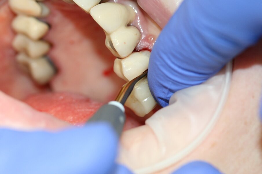 Fig. 5: The tooth was luxated with Luxator P4 (dual edge, lilac). 