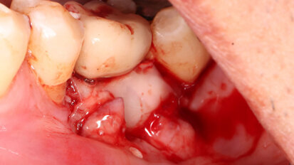3D printing is not the perfect answer to periodontal regeneration, but it is getting close
