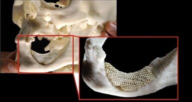 Botmatrix voor herstel grote tand- en kaakbotdefecten