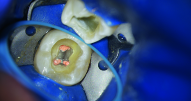 From a distal