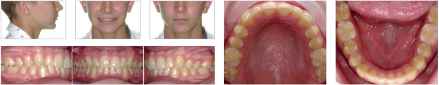 Final after an additional aligners phase of U:25 + L:25 aligners, changed weekly (10 months total)
