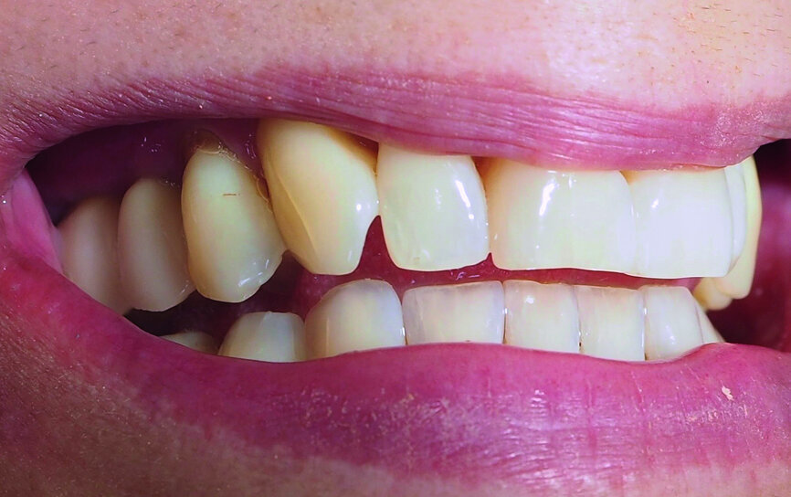 Fig. 25: Natural-looking final restoration.