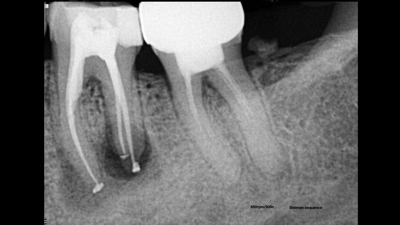 Fig. 5: Immediate postoperative radiograph.