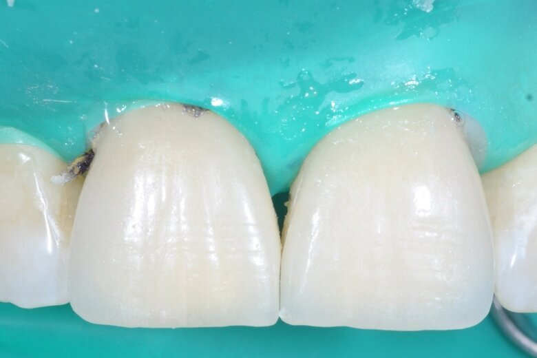 Fig. 23 Immediately after adhesive cementation with PANAVIA V5.