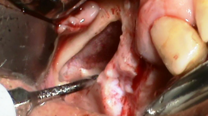 La chirurgia piezoelettrica del seno mascellare: indicazioni cliniche e descrizione di un case series