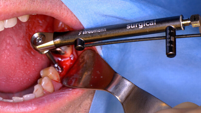 Straumann BLX implant: First human case study yields positive results for molar replacement