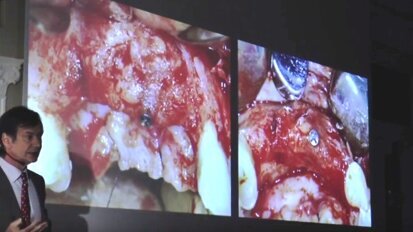 „Kierunki dla implantologii i inżynierii tkankowej” – powodzenie implantów maszynowych i GBR