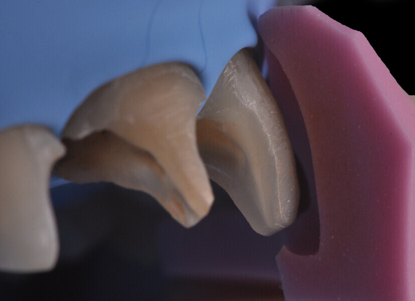 Fig. 10: Checking of the space available in the vestibular area with a second silicone index.