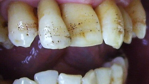 Er:YAG laser conditioning of hypoplastic enamel