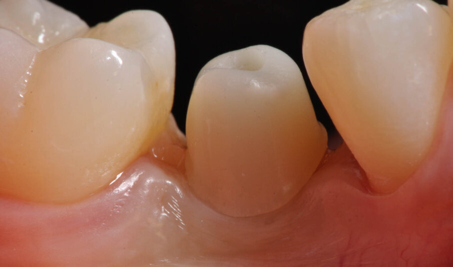 Fig. 13_Lo strato inferiore abutment serrato in posizione realizzato in Enamic IS.