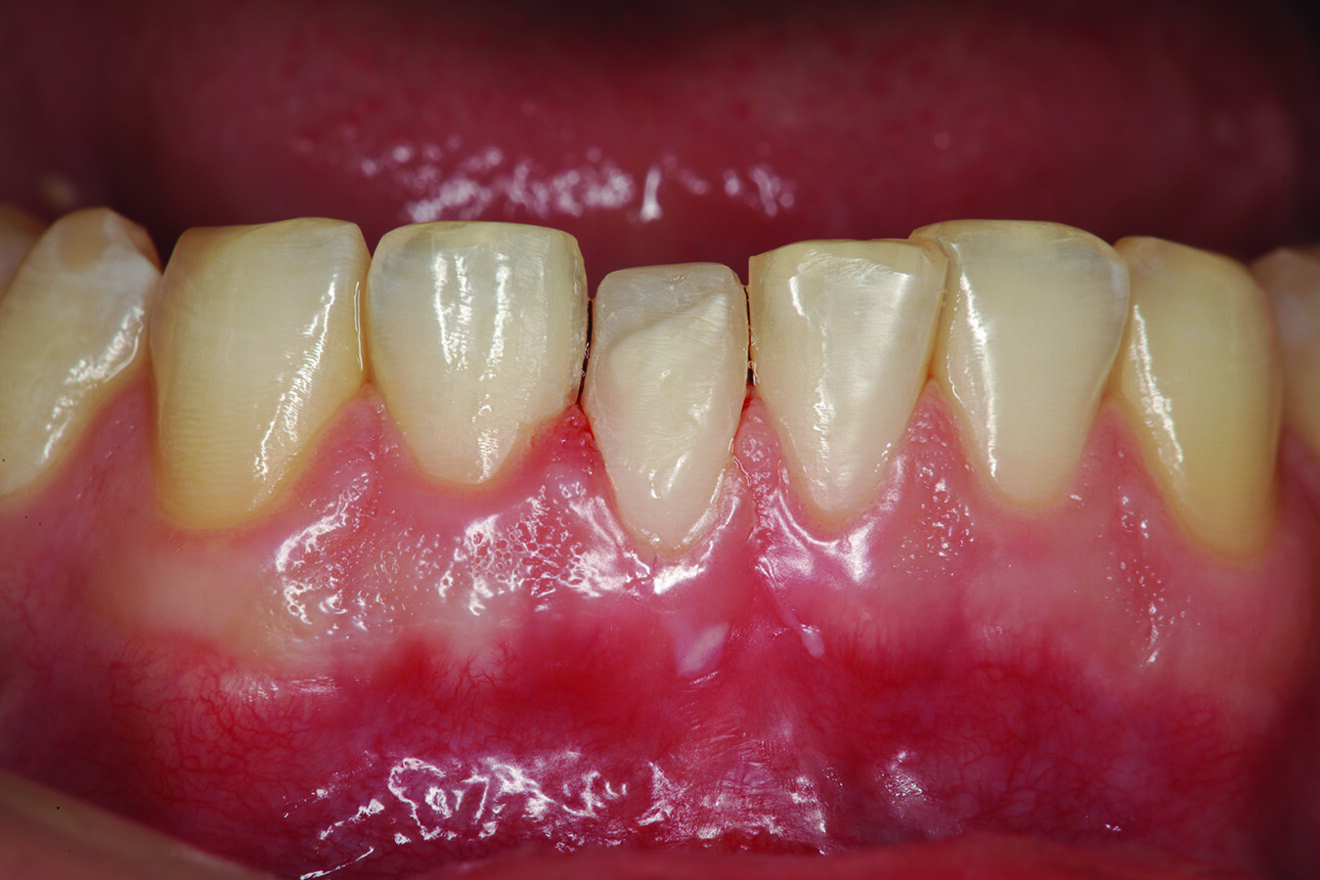 Fig. 6: Lingual aspect of tooth #41 being built up in composite to reposition the incisal edge of the tooth lingually into a more favourable alignment.
