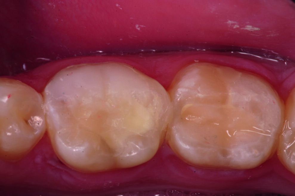 Fig. 8 : Polissage du composite.