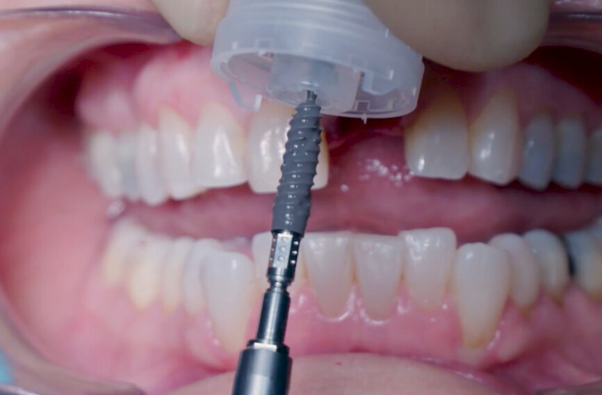 Fig. 9: Implant pick-up.