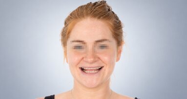 Approccio conservativo multimateriale alla riabilitazione full-mouth in un caso di grave usura dentale erosiva