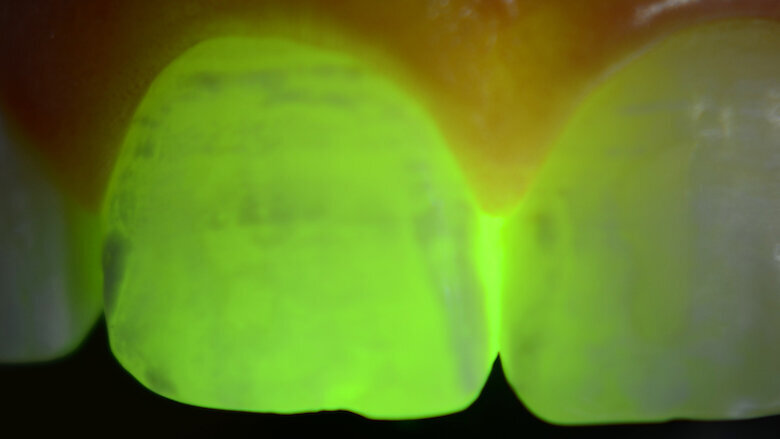 Foto 5. Diente 11. Mediante transiluminación se observa la poca profundidad de las lesiones con un buen pronóstico.
