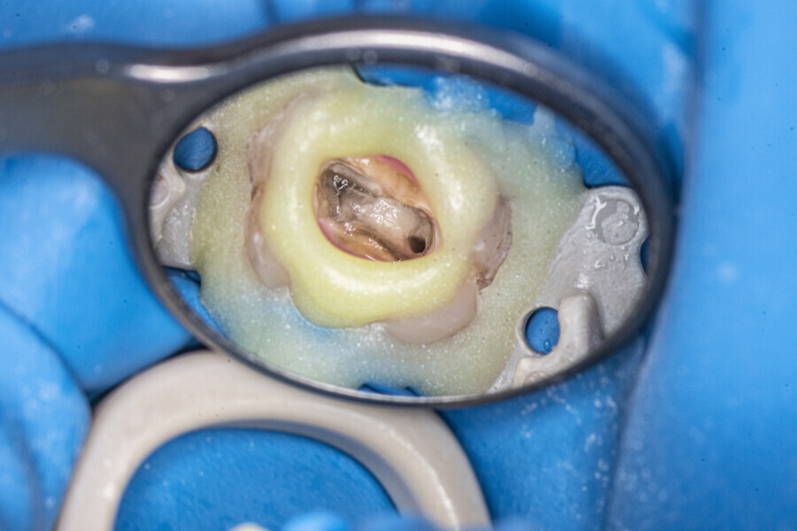 Fig. 53: Partially removed calcification. The orifice of the palatal canal could be seen.