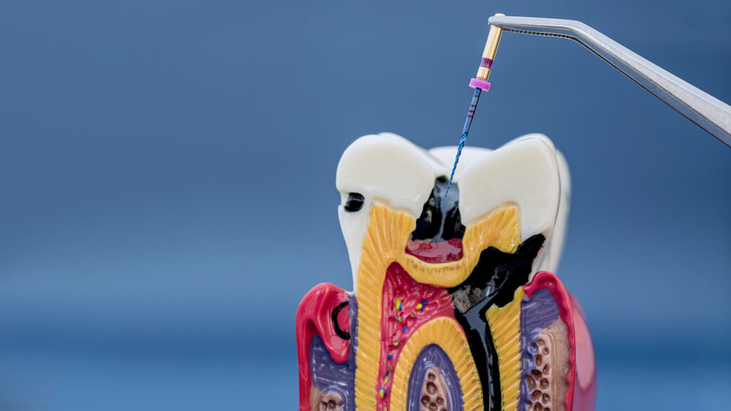 New glossary aims to standardise root and canal anatomy terminology