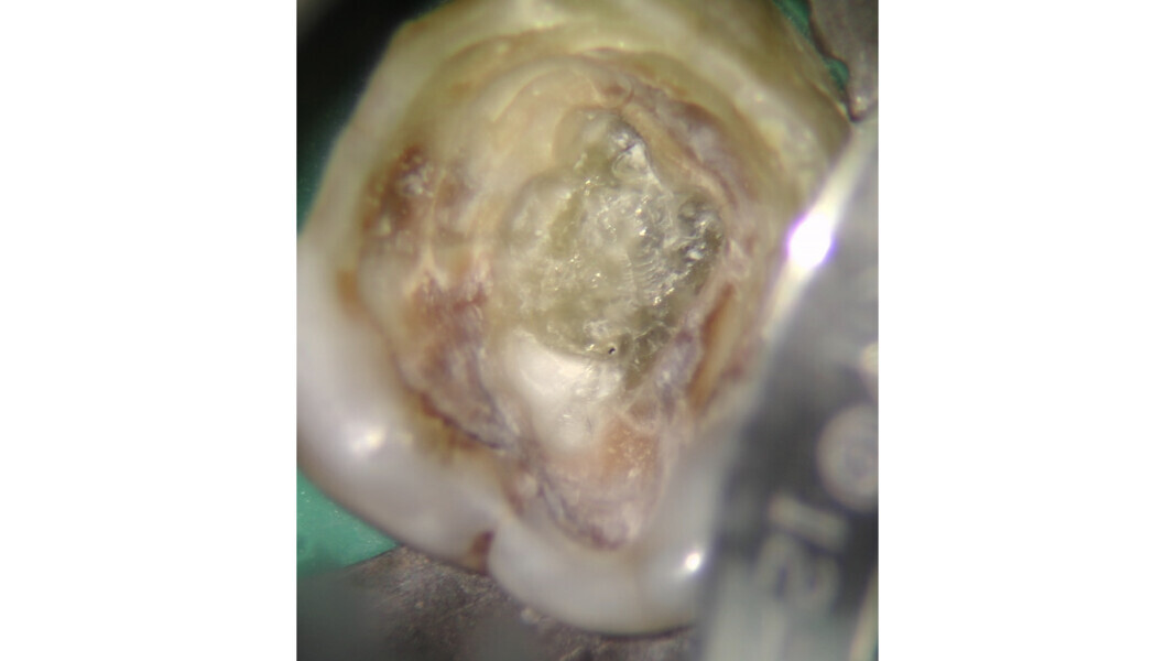 Fig. 22: Preparation of the access cavity and identification of a layer of vitrified and shiny calcified dentine.