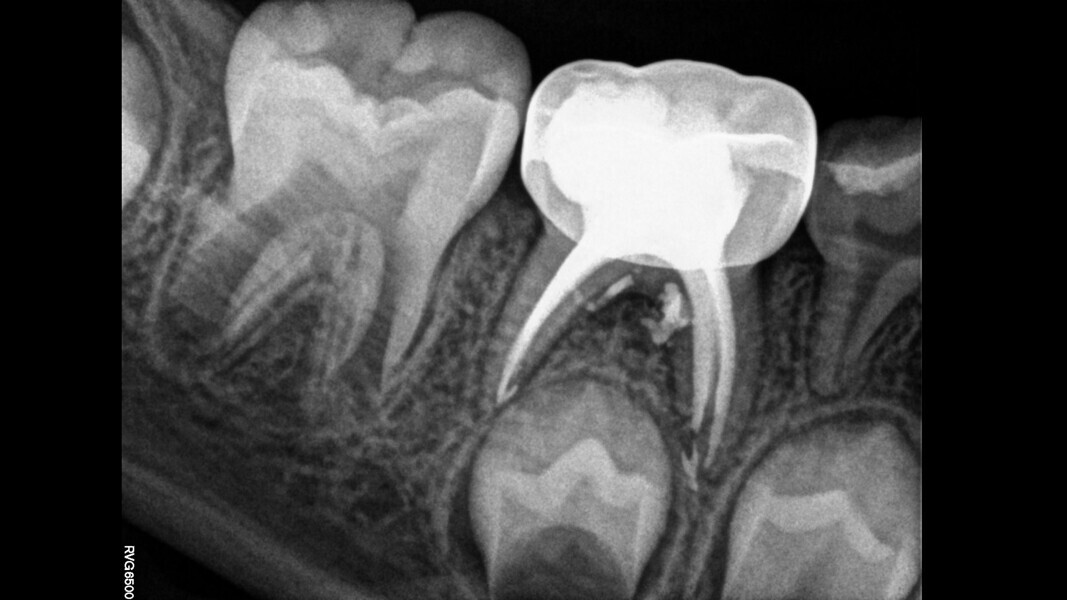 Fig. 4: Fifteen-month control showing bone deposition in the furcal area.