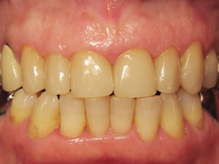 Fig. 10: Porcelain crowns luted with Futurabond DC and Bifix QM (VOCO). 