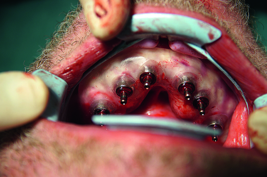 Fig. 18 : Tous les implants CAMLOG guidés dans la mandibule. 