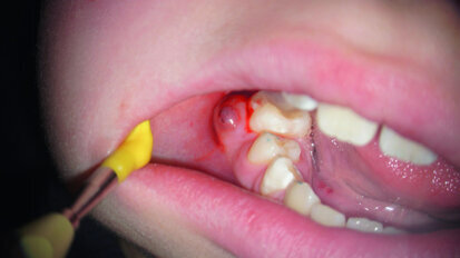 Apical lesions: To treat or not to treat?