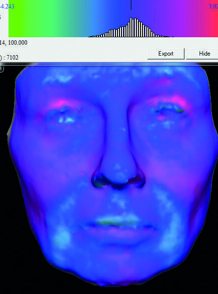 Fig.3 : Prétraitement facial, post-traitement facial six mois et neuf mois après, et enfin, évaluation morphométrique du changement.