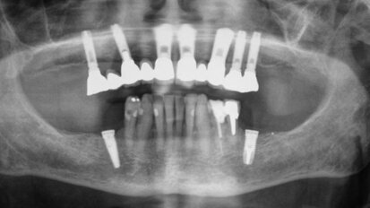 Les implants dentaires entraînent des risques de lésions nerveuses