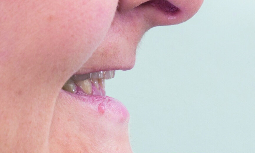 Fig. 2: Considerably shortened tooth crowns due to bruxism.
